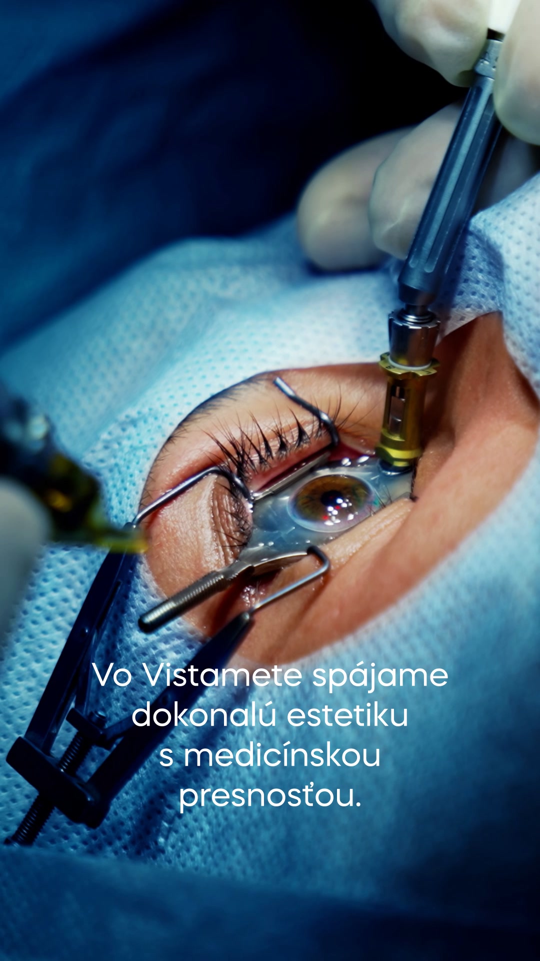 Ak je váš zrak v poriadku a vaše oči sú zdravé, vieme sa pozrieť na to, ako zlepšiť vzhľad očného okolia a zachovať jeho svieži, mladistvý výraz. 🌟

Vykonávame najmä plastické operácie očných viečok (blefaroplastiku), chirurgickú korekciu postavenia dolných mihalníc pri ektropiu a entropiu, odstraňovanie drobných kožných výrastkov a nerovností (bradavičky, znamienka, cysty, aterómy, míliá, xantelazmy), ako aj odstránenie nádorových útvarov (fibróm, lipóm, bazalióm) s možnosťou histologického vyšetrenia. Súčasťou našej starostlivosti je aj liečba chalaziónu (jačmeňa) a chirurgické riešenie pterýgia. 👀

Všetky zákroky vykonáva skúsený oftalmologický a chirurgický tím s dôrazom na precíznosť, bezpečnosť a individuálny prístup. Zákroky prebiehajú v lokálnej anestézii, bez nutnosti hospitalizácie, čo umožňuje rýchly návrat k bežným aktivitám. 🏃‍♀️👟

Prečítajte si o službe na ➡️ https://www.vistamet.sk/esteticka-chirurgia